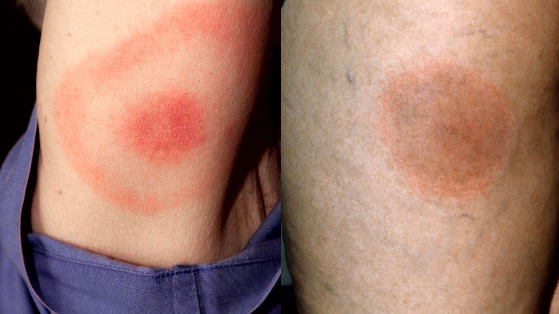 4 things you should know about ticks and Lyme disease this ...