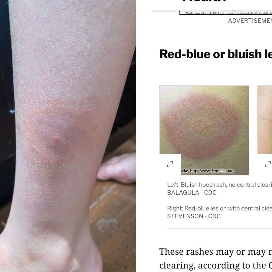 Does this look like Lyme disease?