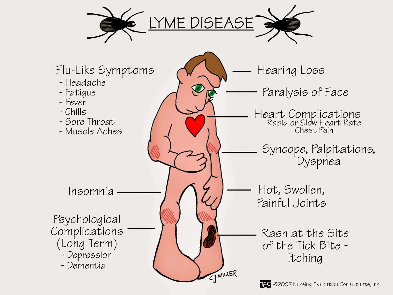 Lyme Disease Contagious