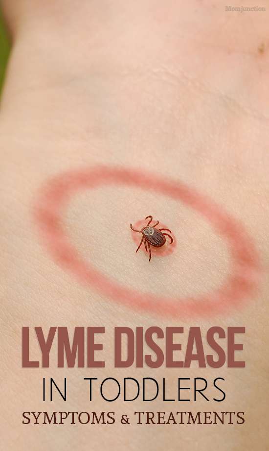 Lyme Disease In Toddlers