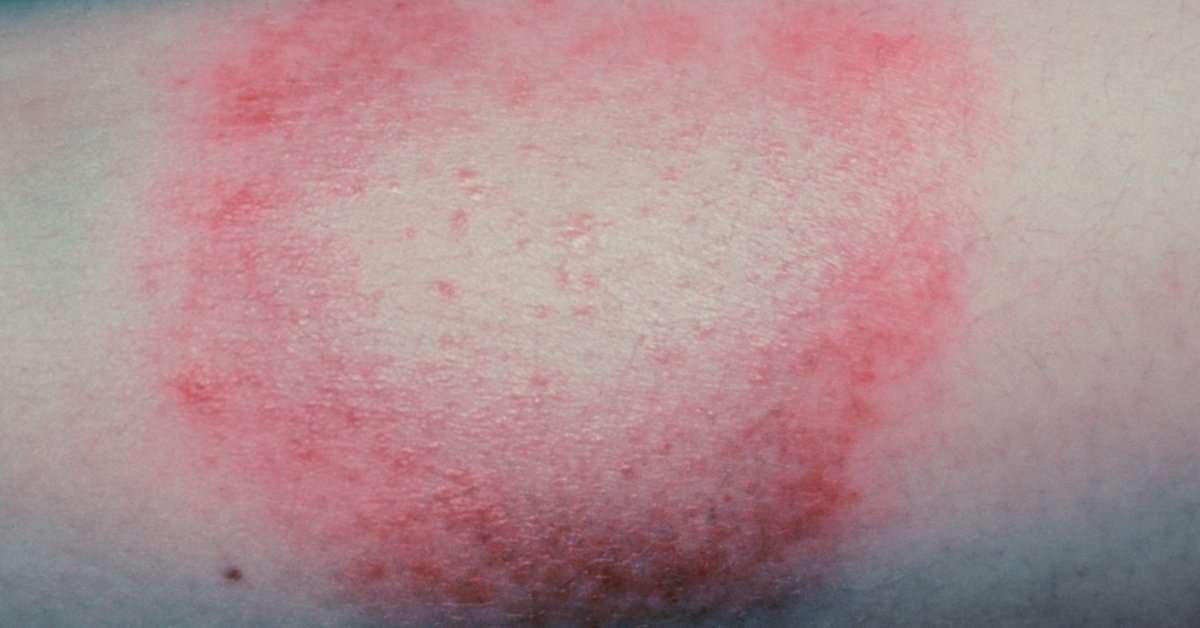 Lyme Disease: Long Term Antibiotics May Not Help