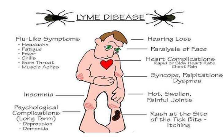 Lyme Disease Symptoms and Treatment with prevention Tips