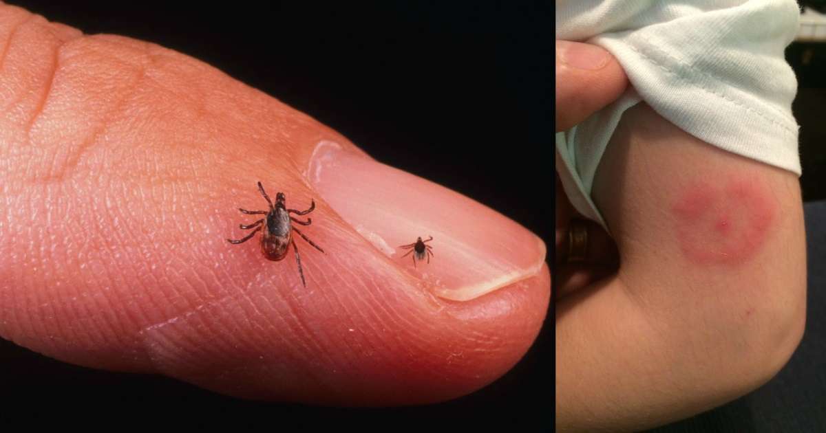 What is Lyme Disease? Symptoms and How to Cure it
