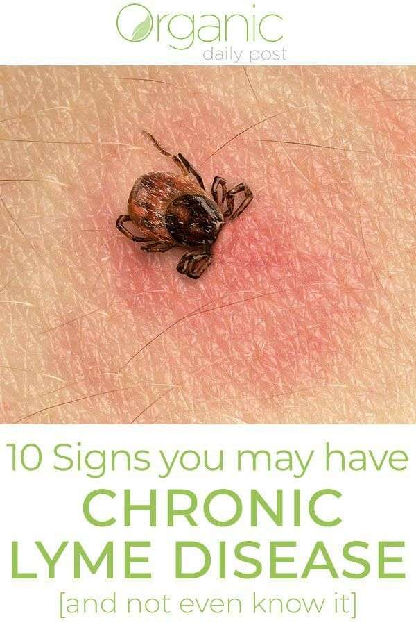 10 Signs You May Have Chronic Lyme Diseaseâ¦And Not Even ...