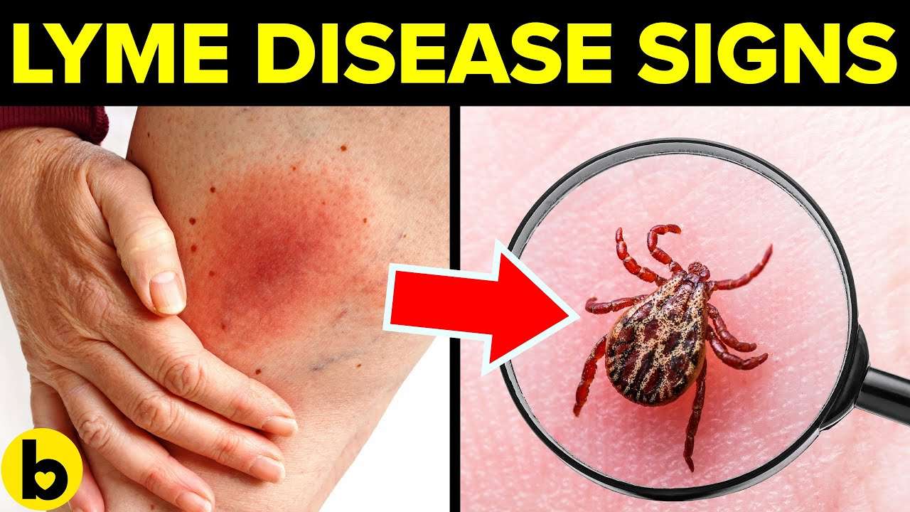 7 Early Signs And Symptoms Of Lyme Disease