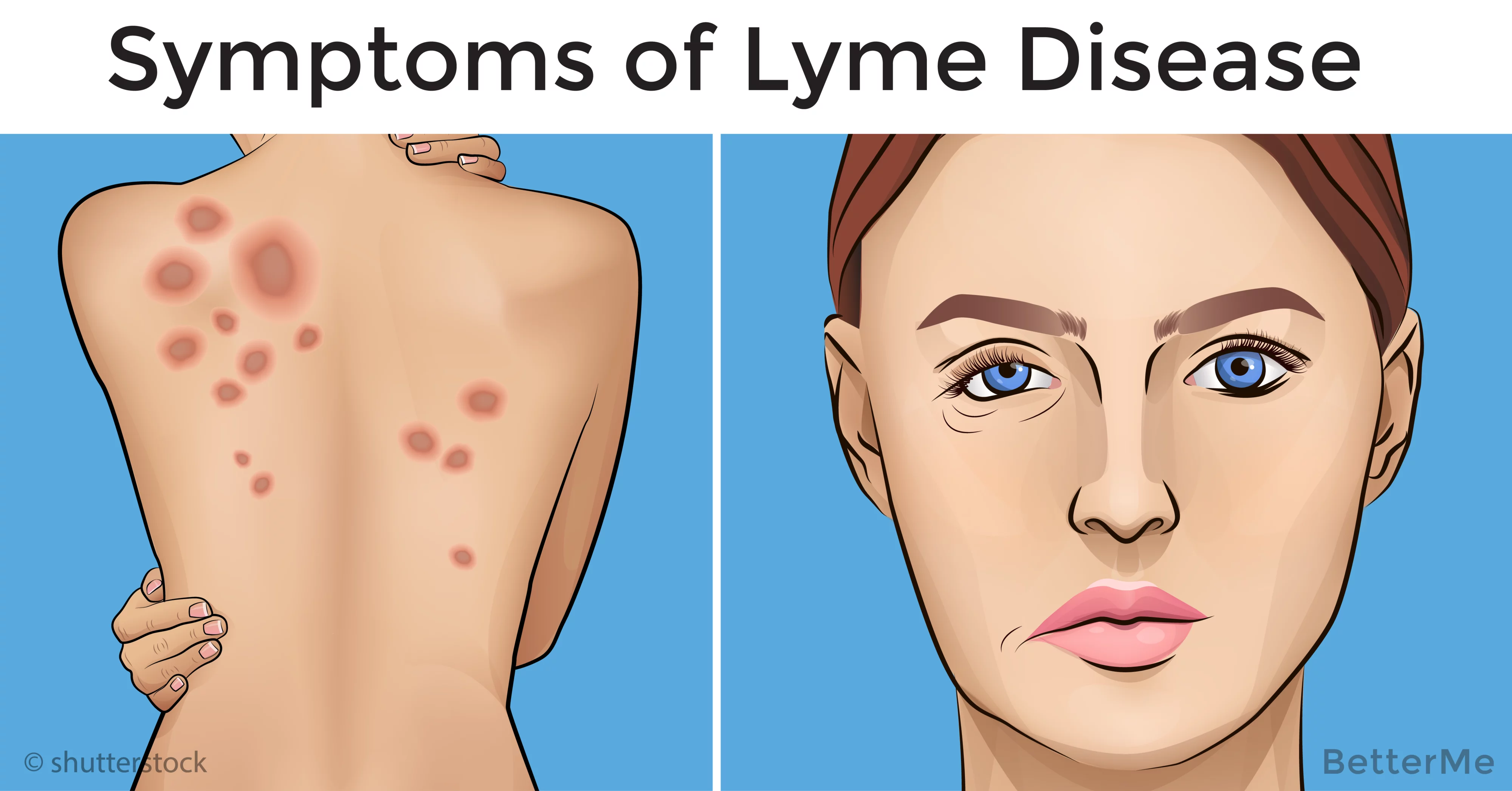 Be careful! You could have lyme disease and not even know it.