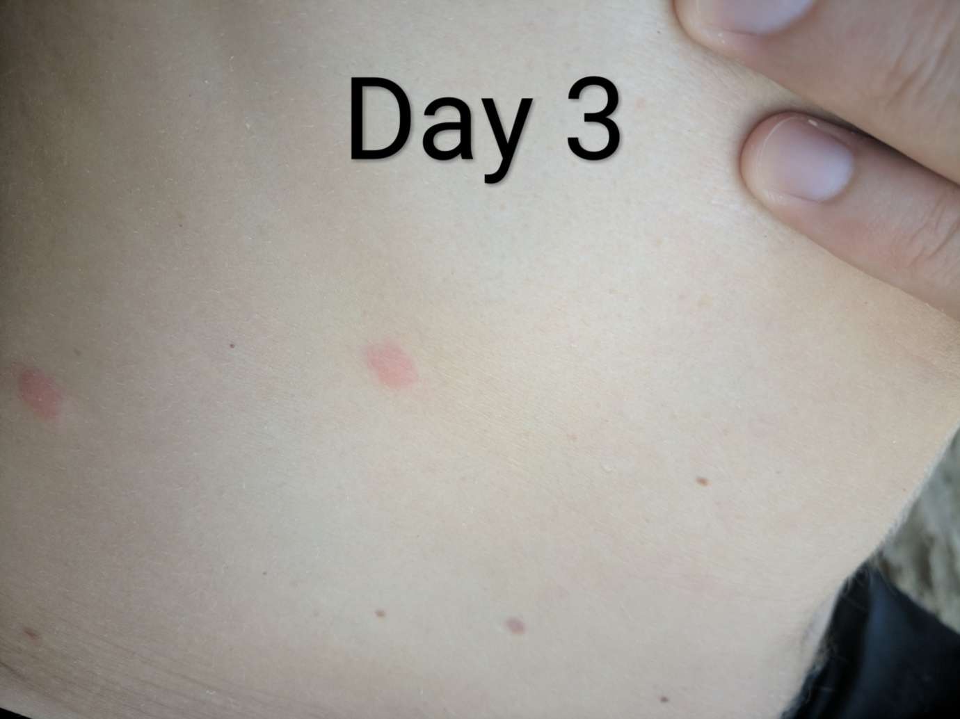 Bullseye rash: lyme disease or just a look