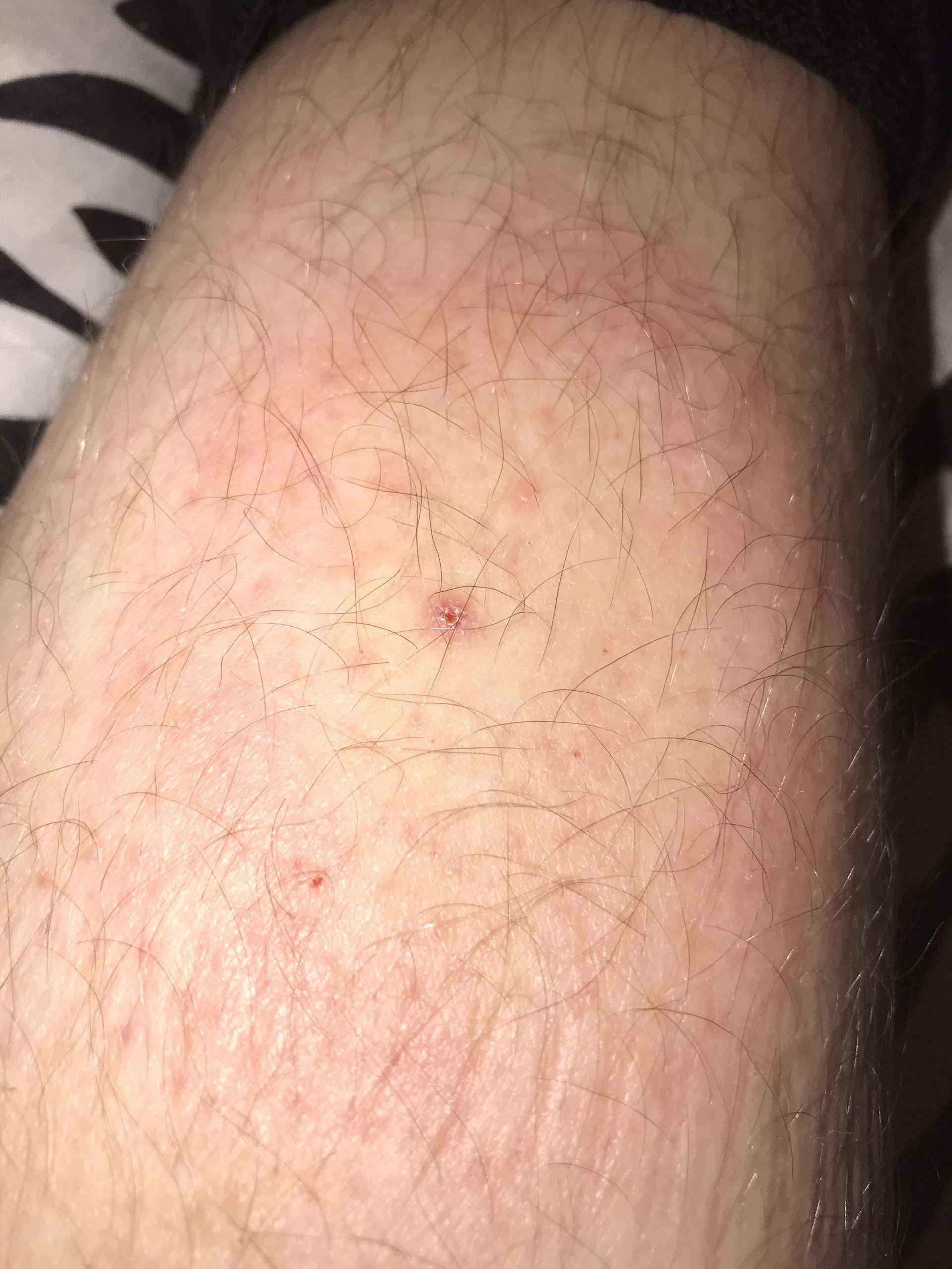 Help does anyone know if this is Lyme disease or some ...