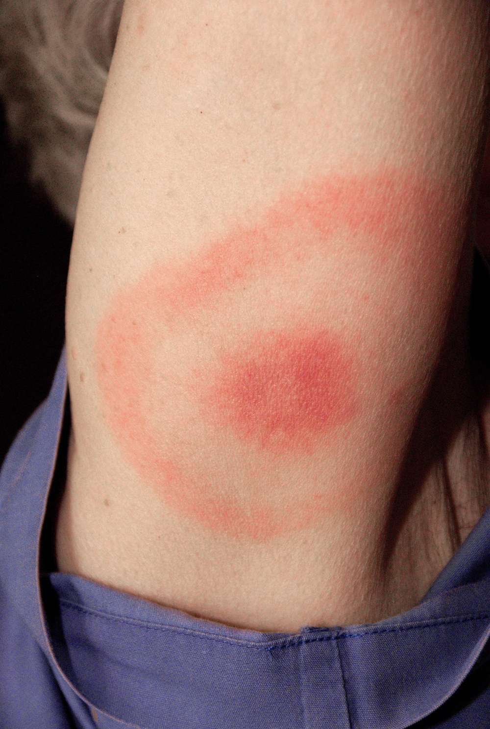 How Much Lyme Disease Are We Living With?