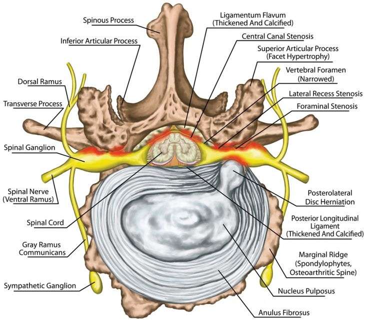 lateral recess stenosis