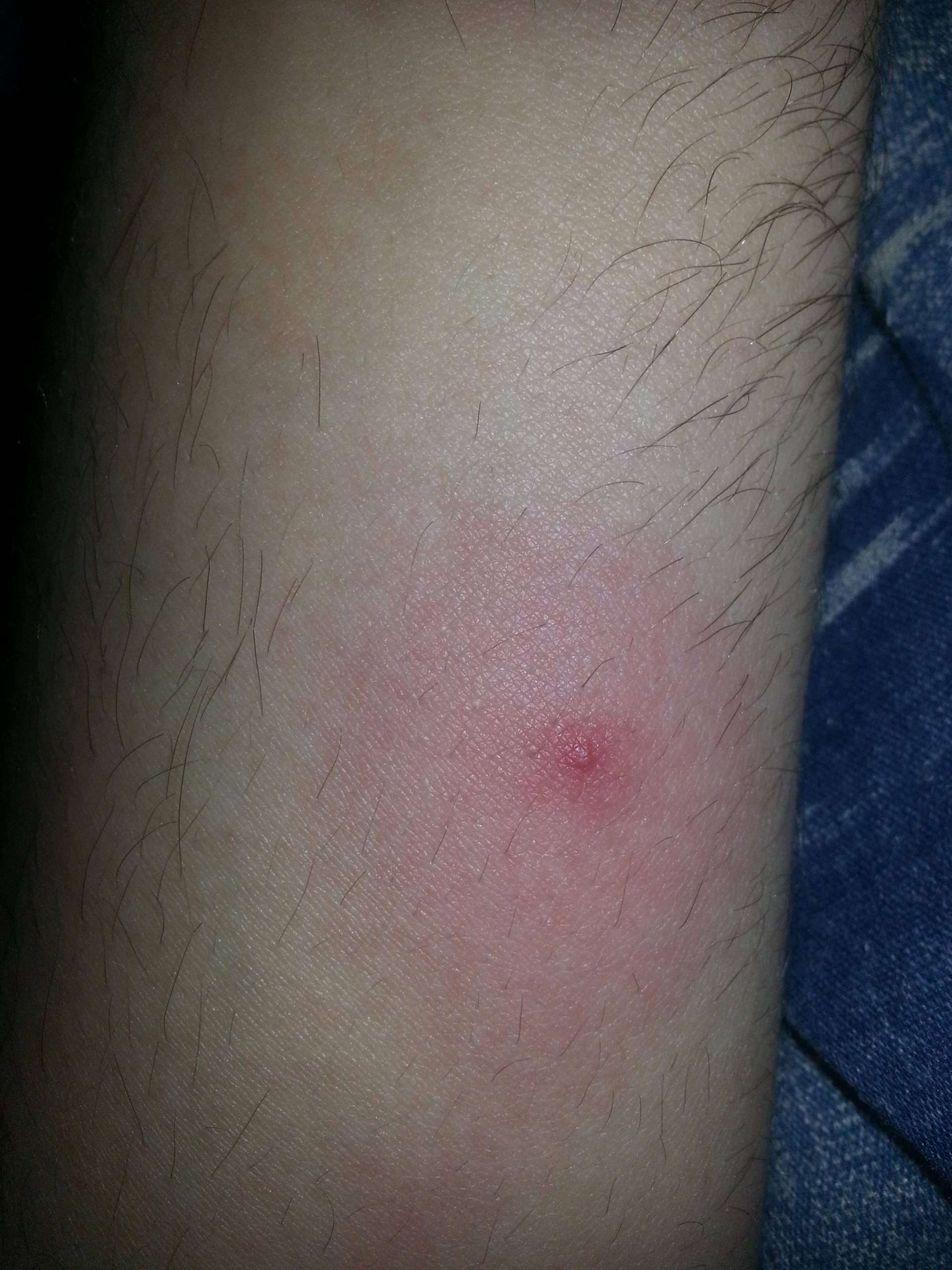 Live in RI, worried about lyme disease after getting bit ...