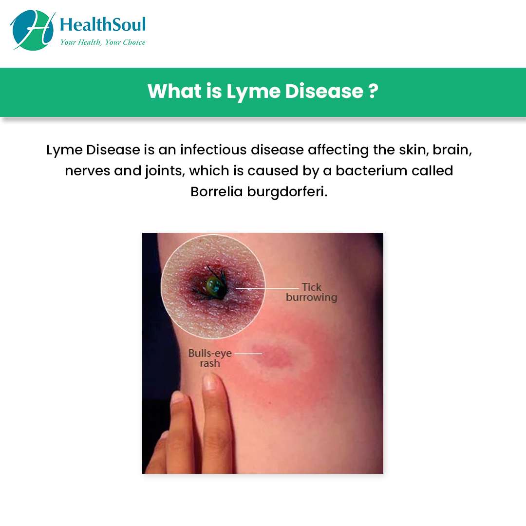 Lyme Disease: Symptoms and Prevention