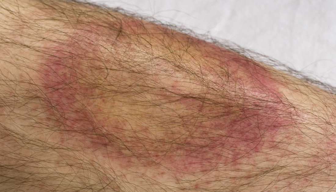 Lyme disease: Symptoms, transmission, and treatment
