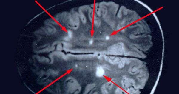MRI Multiple Sclerosis Lesions