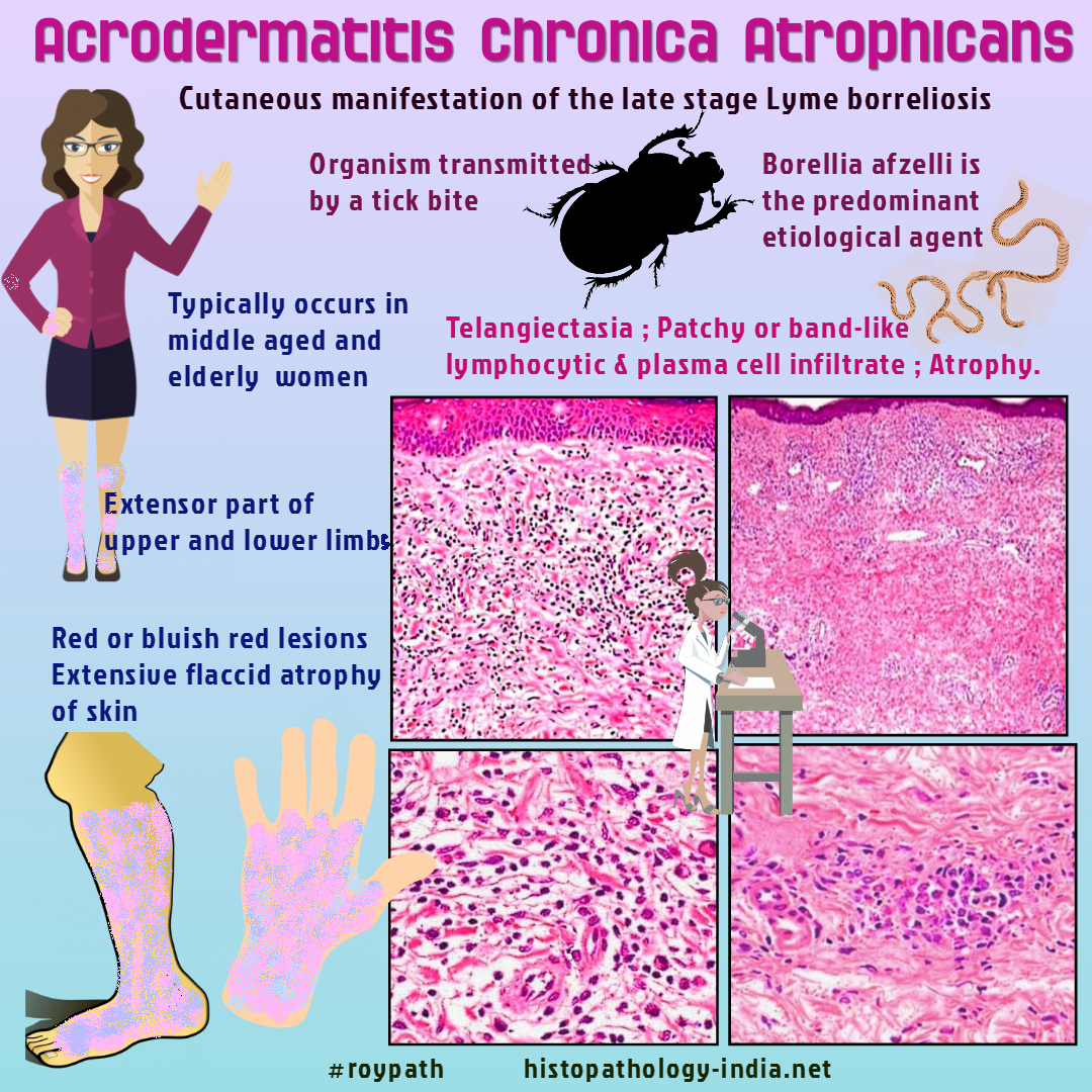 Pathology of Acrodermatitis Chronica Atrophicans ...