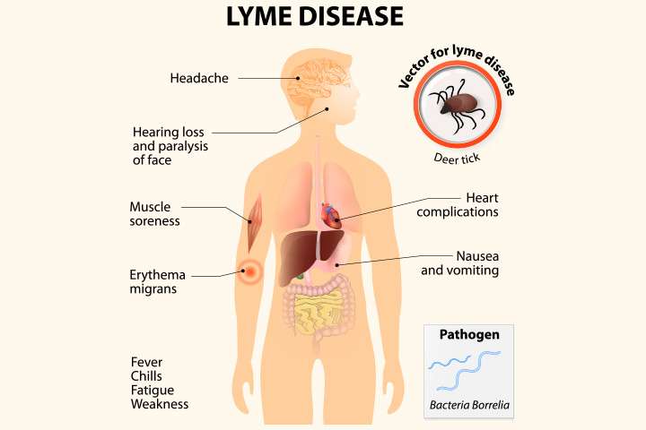 Test for Lyme Disease