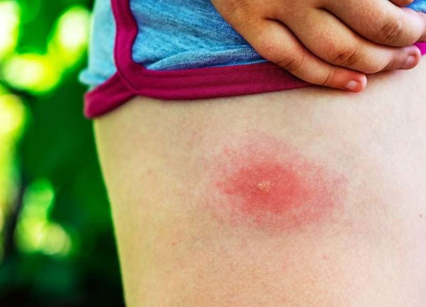 The Bite Of Life: How To Tell If You Have Lyme Disease?