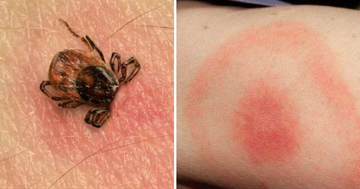 These are the signs of a tick bite to look for this season