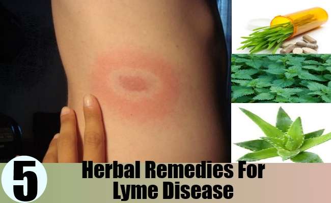 Top 5 Herbal Remedies For Lyme Disease  Natural Home ...