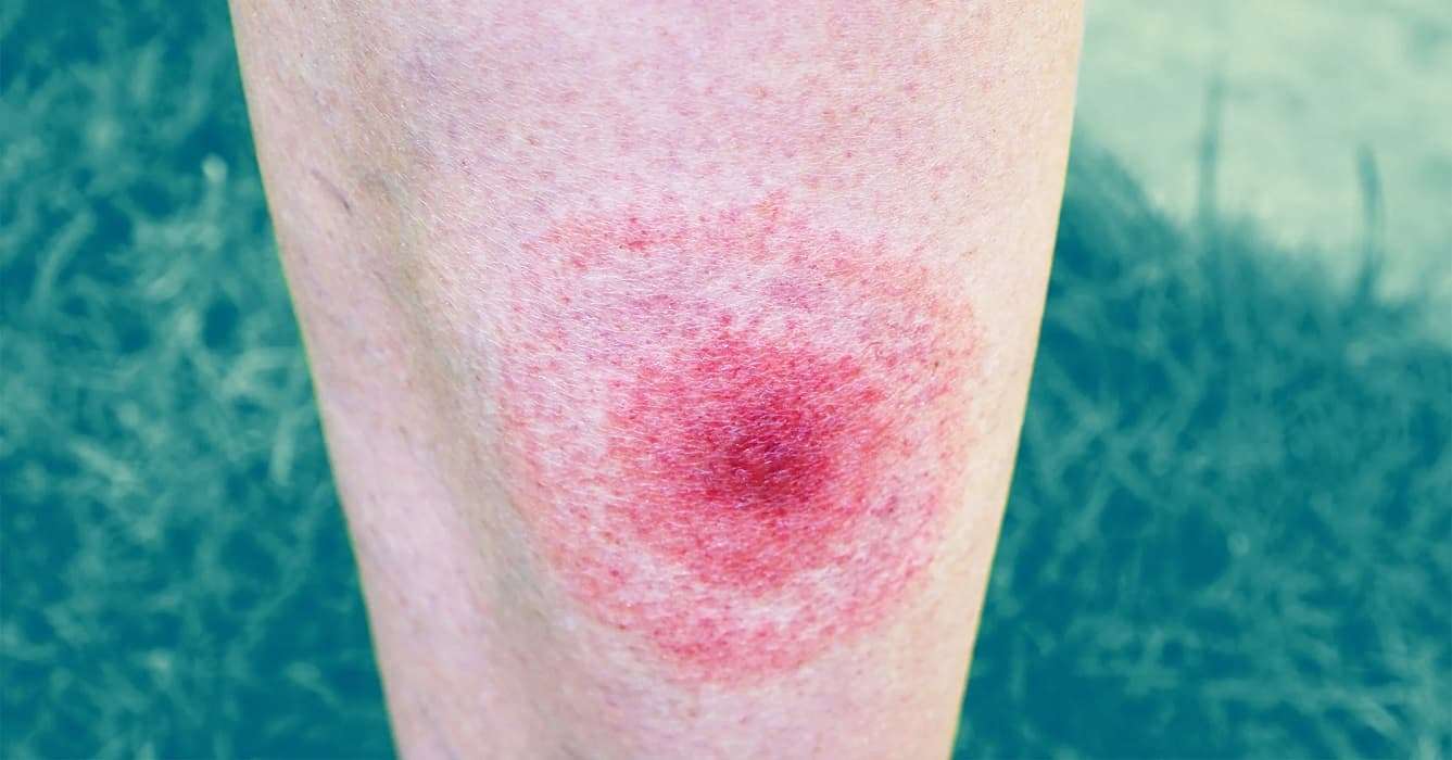 What Does a Lyme Disease Rash Really Look Like? These ...