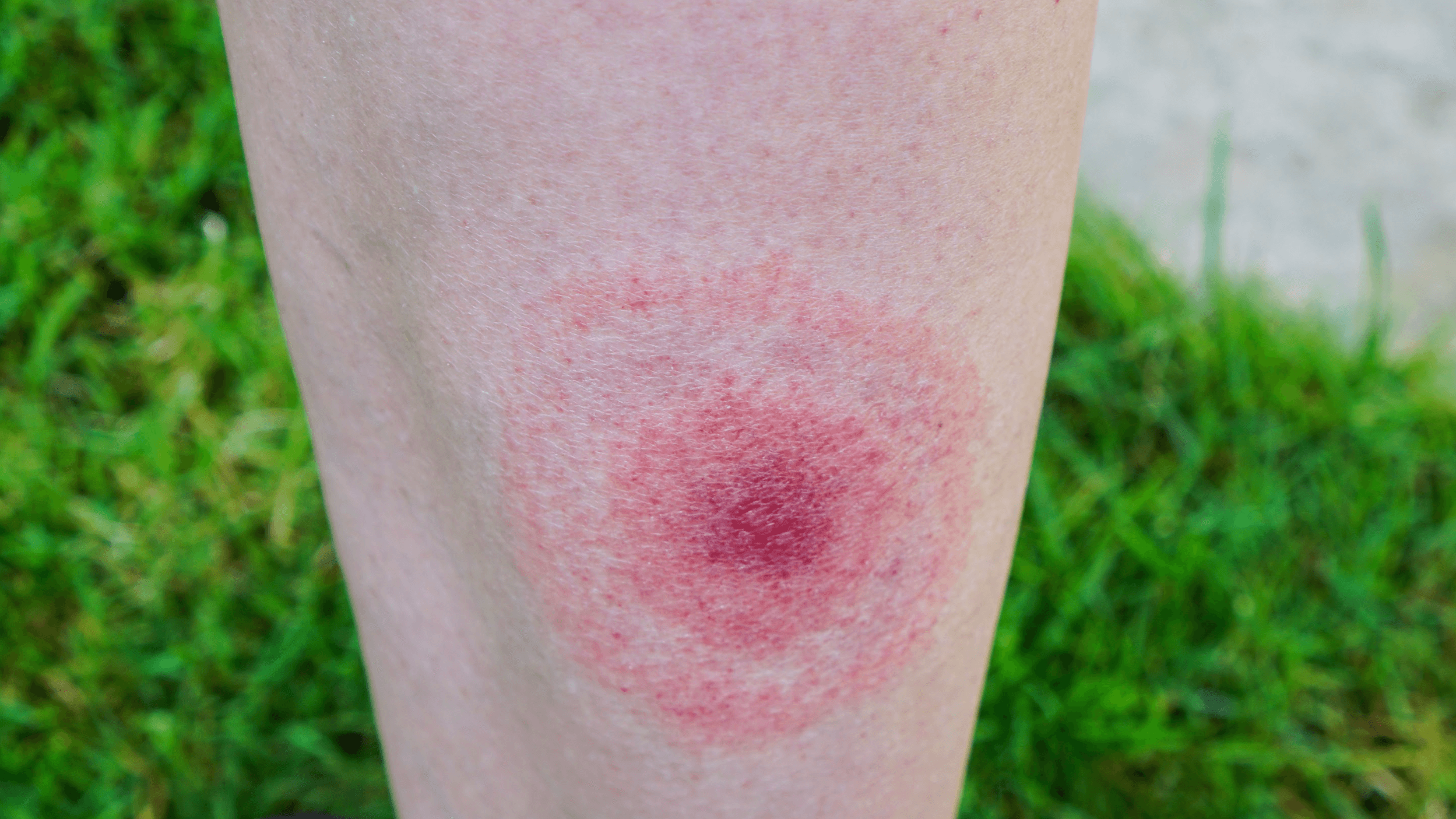 Will Lyme Disease Go Away on its Own?