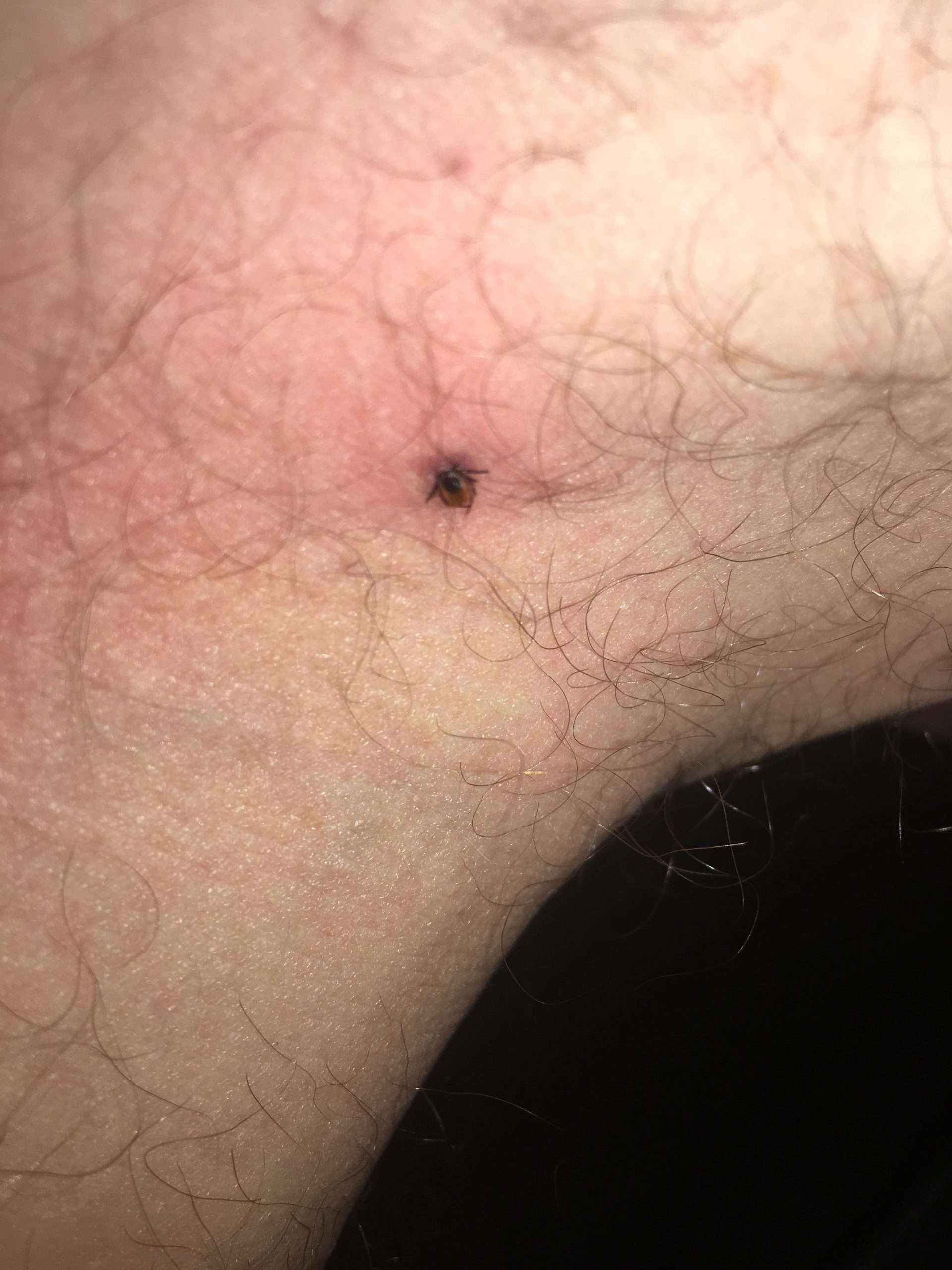 I got bit by a tick, removed it but lost the body. Can I ...