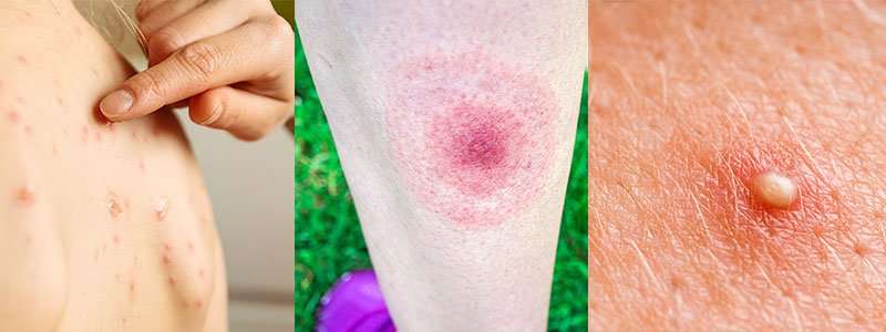Lyme Disease Frequently Asked Questions (FAQs ...