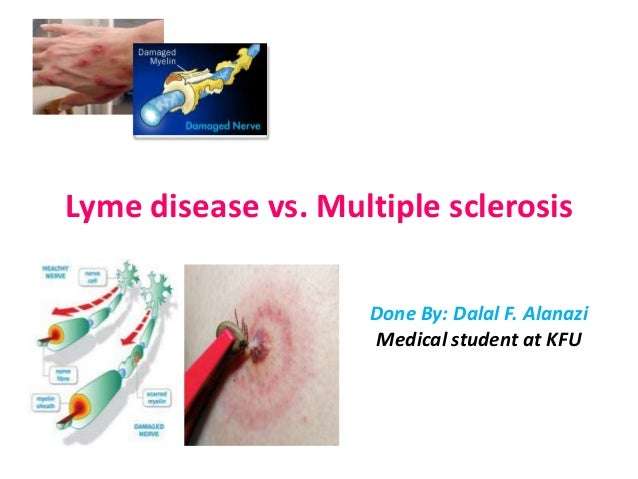 Lyme disease vs. ms