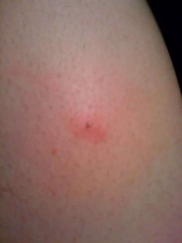pictures of lyme disease rashes