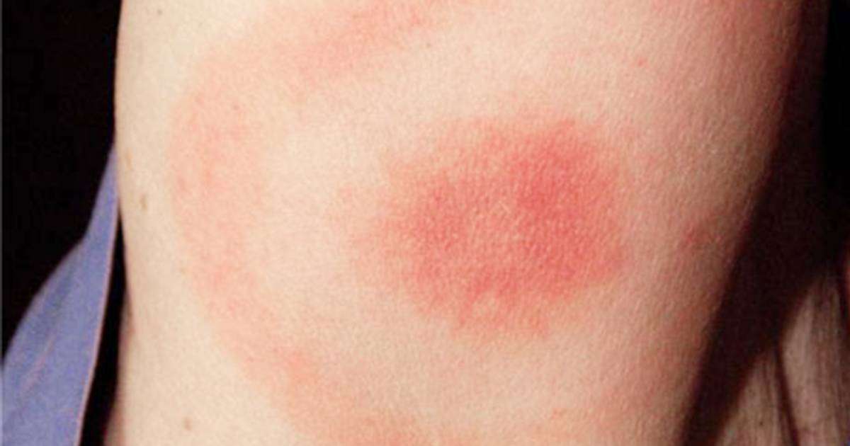 Symptoms of Lyme disease: why the disease is so hard to ...