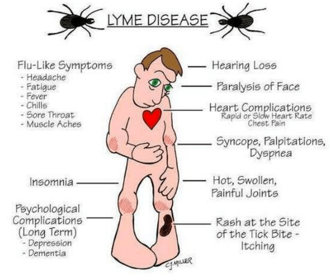 What are the Symptoms of Lyme disease?