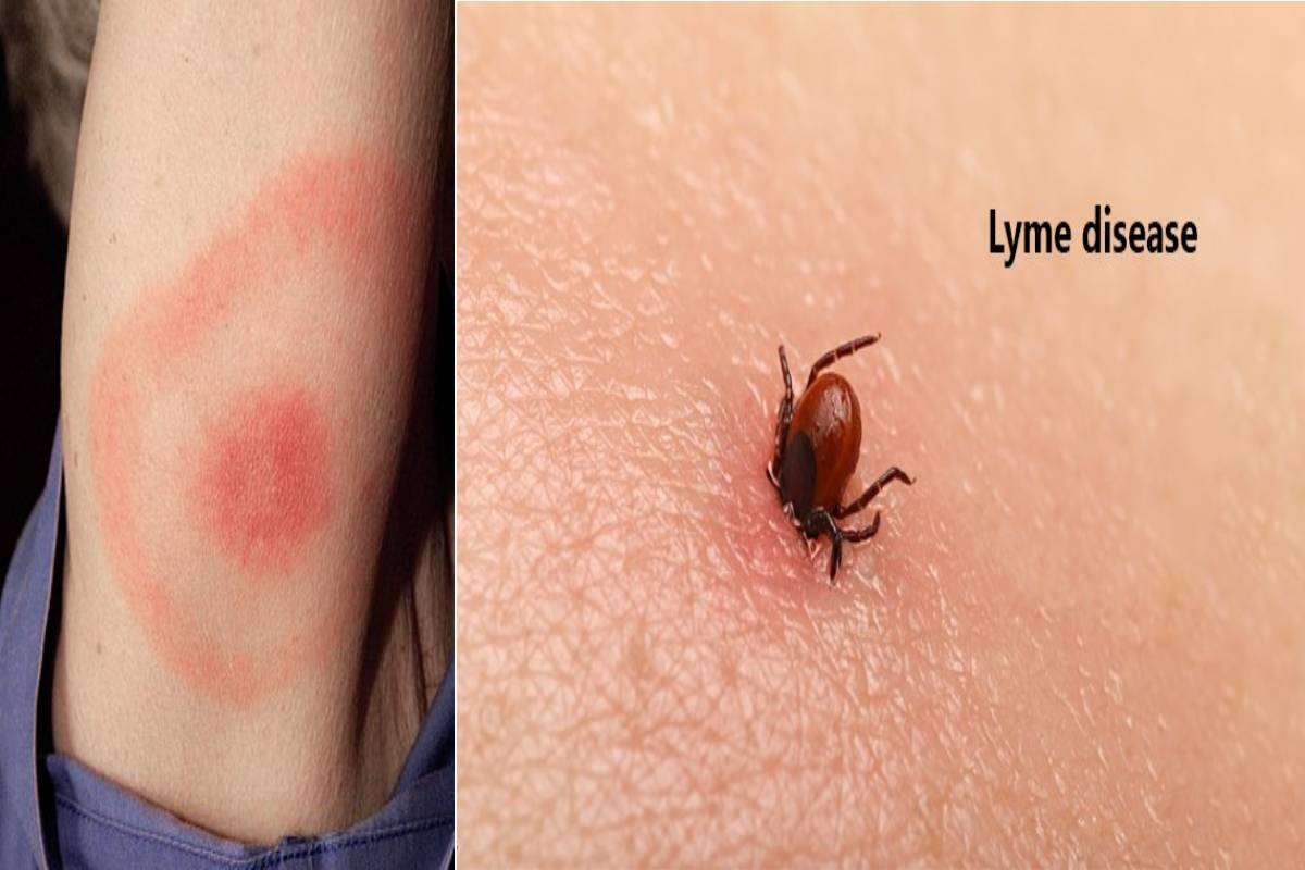 What is Lyme Disease?  Causes, Symptoms, Diagnoses, and More