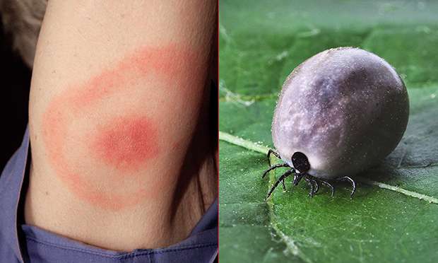Woman catches Lyme disease from tick bite at Clissold Park ...