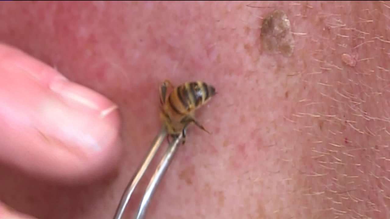 Bee venom therapy used to treat Lyme disease