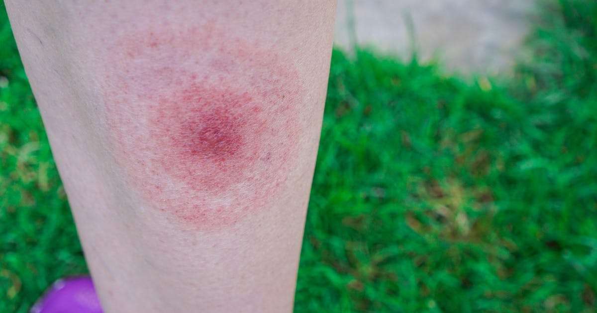 Does Lyme Disease Rash Always Look the Same?