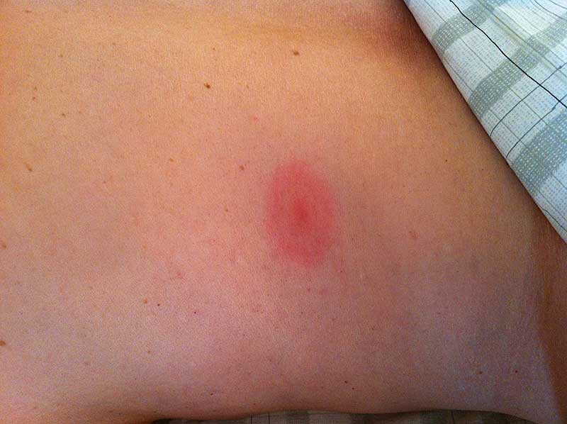 Lyme Disease, What it Looks Like  TOUCH FITNESS