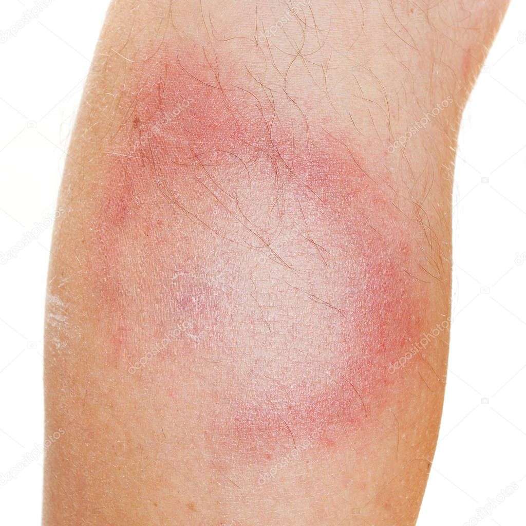 An Erythema Migrans rash, early stage of Lyme disease ...