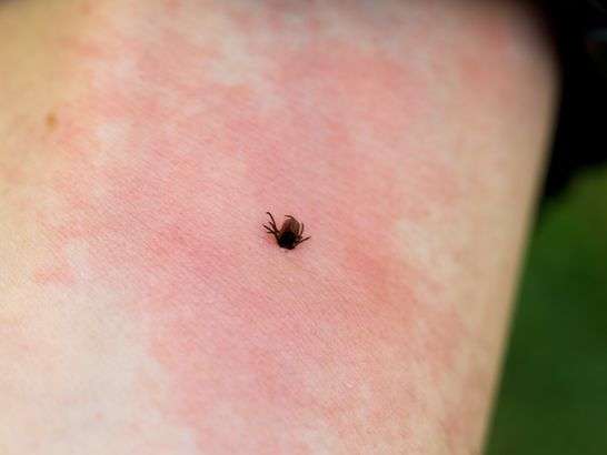 How Do You Get Lyme Disease, and Can It Be Cured ...