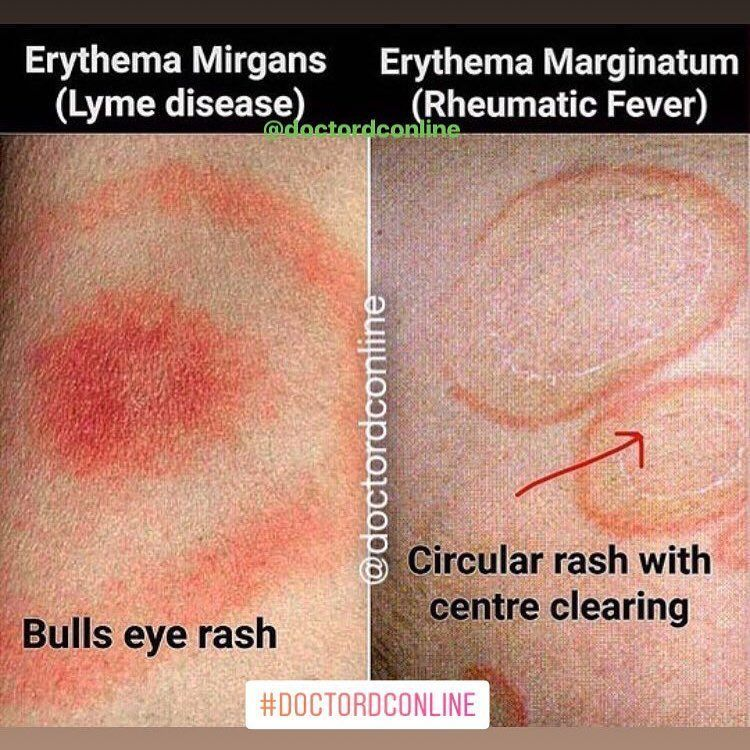 erythema multiforme vs lyme disease