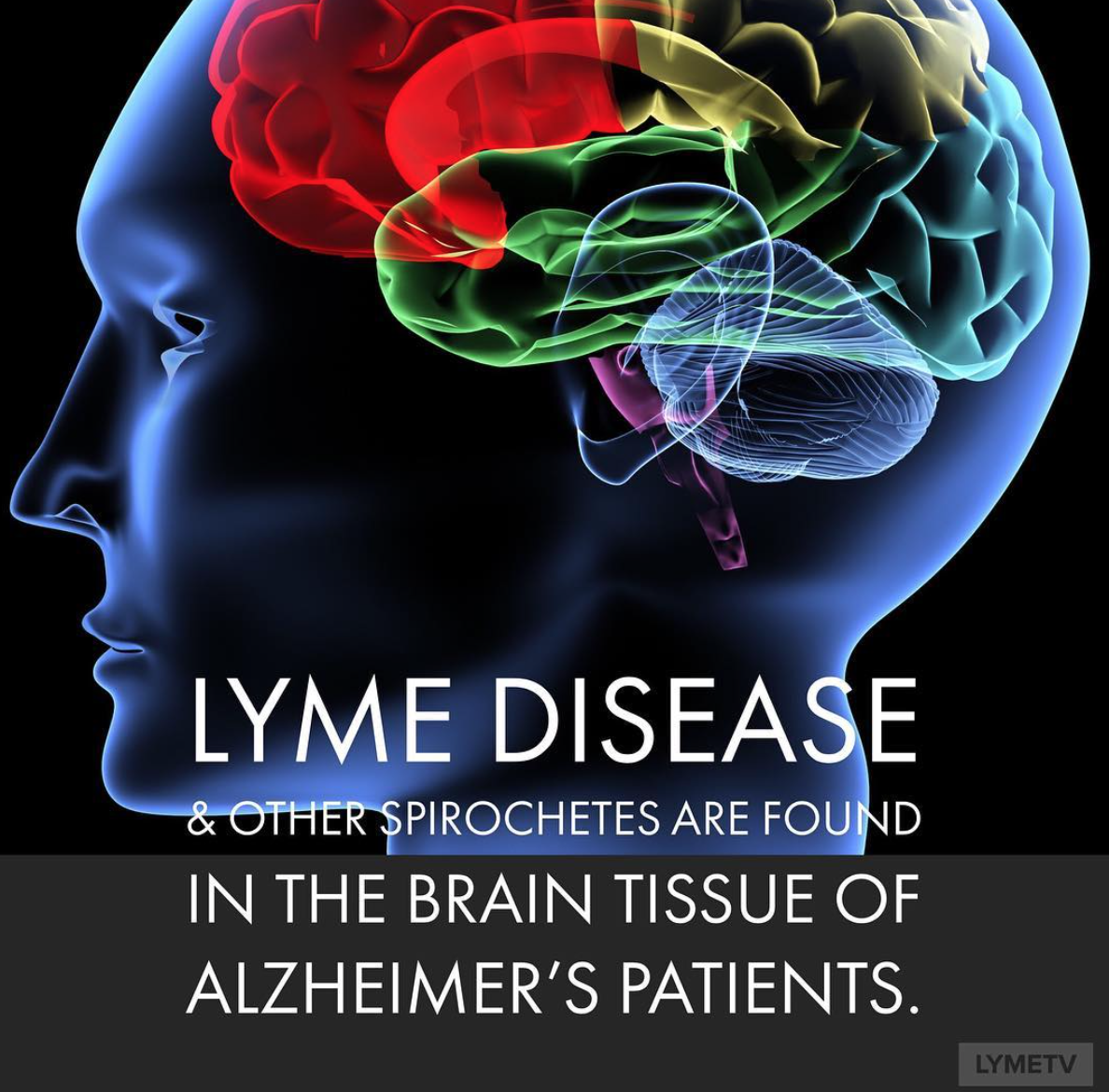 Know the #damage #LymeDisease can cause. Neurological #lyme #disease ...