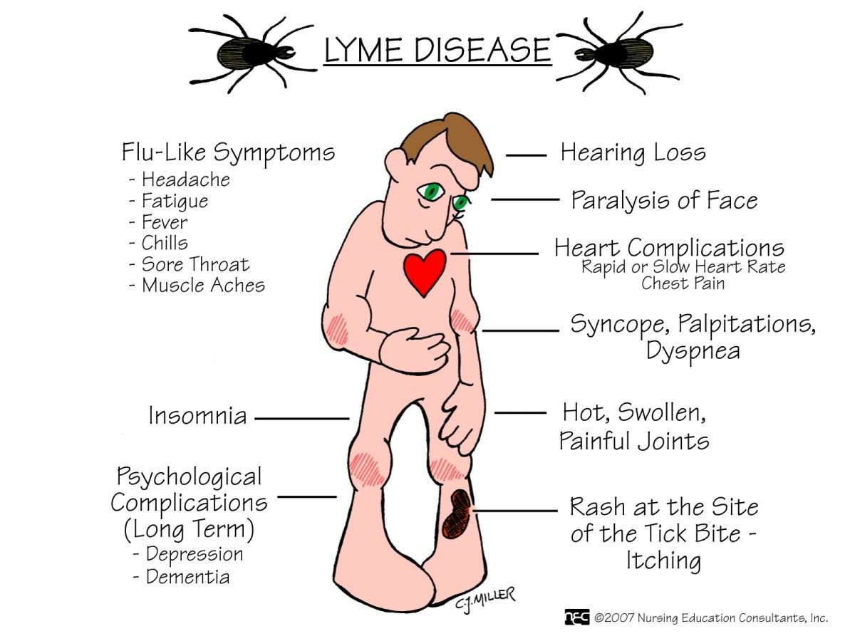 20 belangrijke punten over de ziekte van Lyme  Natuurpraktijk AURORA
