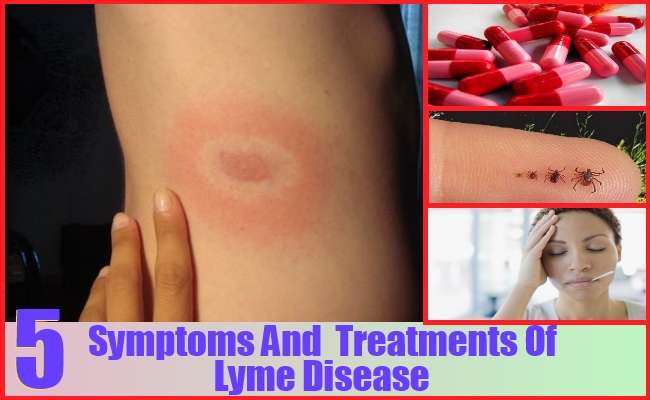 5 Symptoms &  Treatment Of Lyme Disease