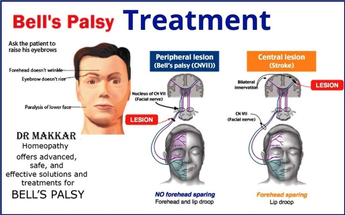 Bells palsy Homeopathic Treatment Idiopathic facial paralysis