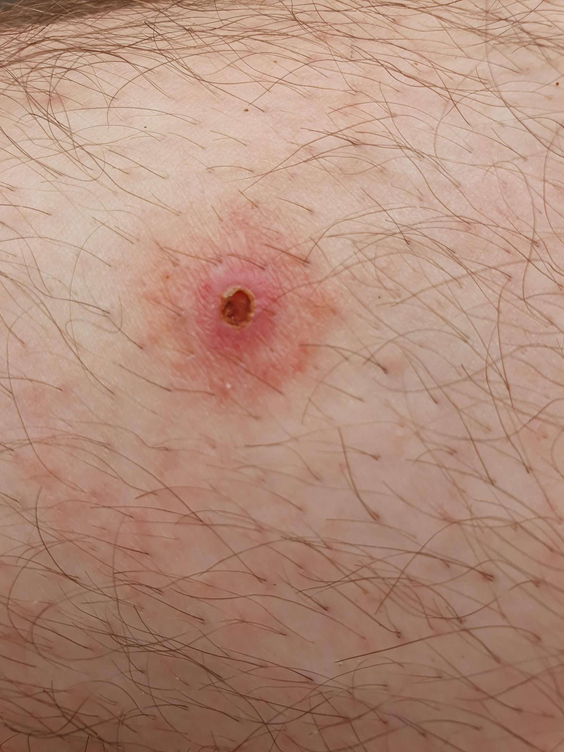 Could this be Lyme disease? : DiagnoseMe