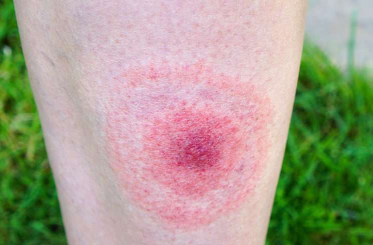 How to Live With Lyme Disease â Cleveland Clinic