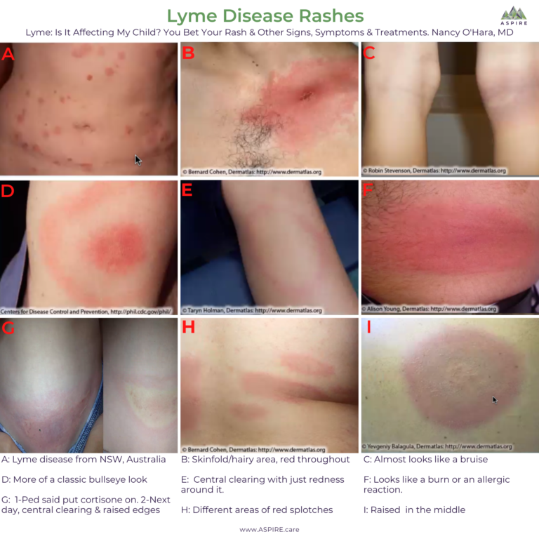 ILADS Lyme Disease Guidance
