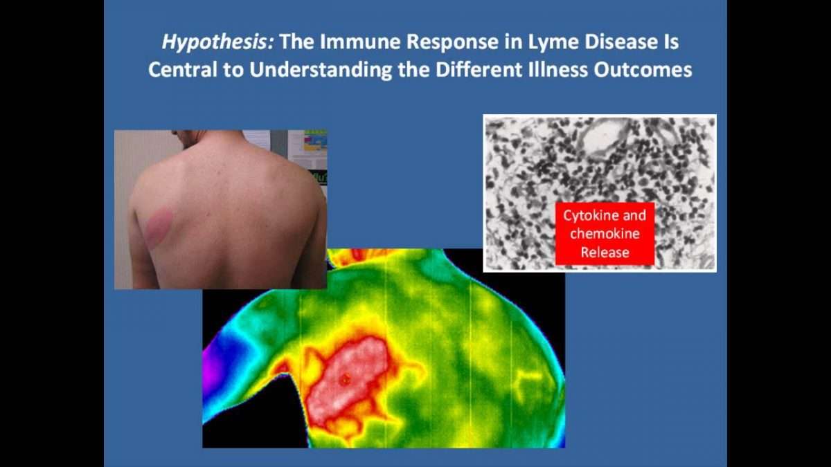 Lyme Disease and Post