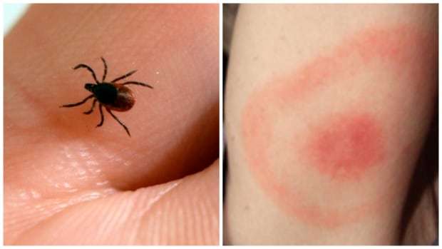 Microbiologist hopes Lyme disease hot zones will get new program