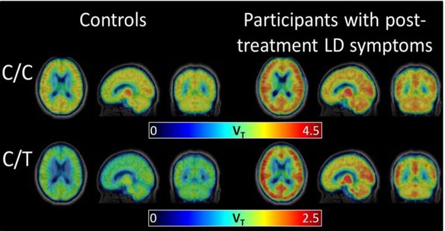 New scan technique reveals brain inflammation associated with post ...