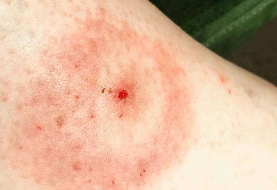 Sufferers of Lyme disease speak out after tick bites